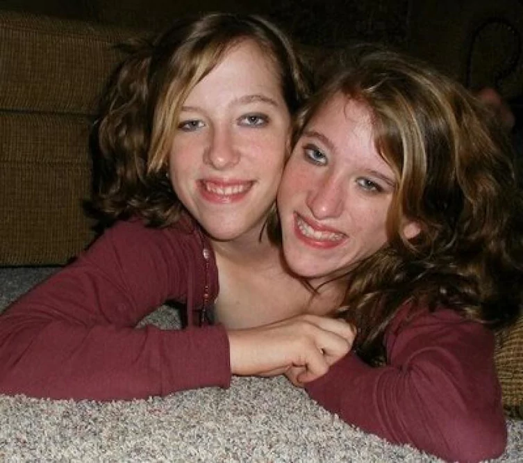 25 Fascinating Facts About Conjoined Twins Abby And Brittany Hensel.